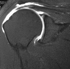 Supraspinatous Tear Moderate Retraction 2